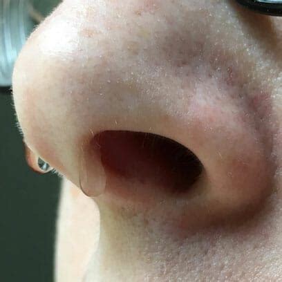 csf yellow fluid leaking from nose|3 Simple Ways to Identify CSF Rhinorrhea